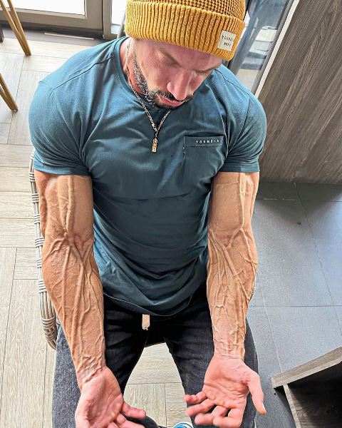 Lebih Tahu Soal Aneurisma, Penyakit yang Dialami Jo Lindner Tutup Usia