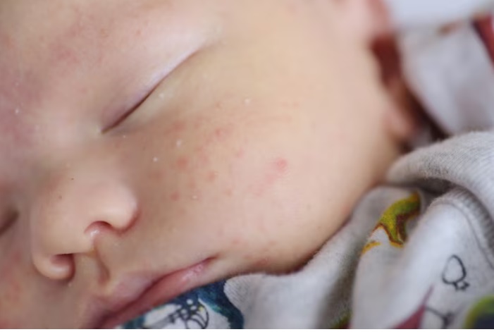 3 Penyebab Jerawat Pada Bayi dan Cara Mengatasinya