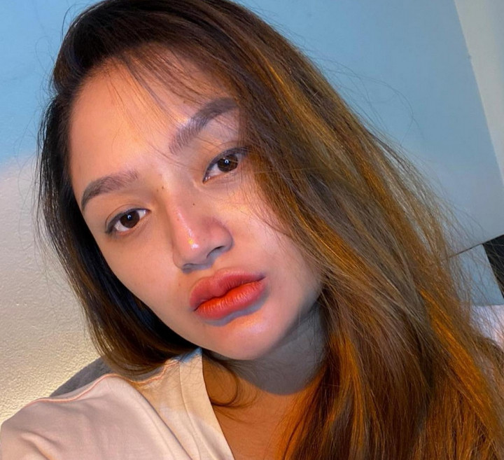 Siti Badriah Awalnya Mengira Punya Jerawat di Ketiak, Ternyata Tumor