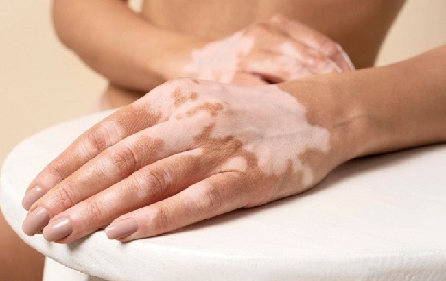 Lebih Tahu tentang Vitiligo, Kondisi Ketika Warna Kulitmu Memudar