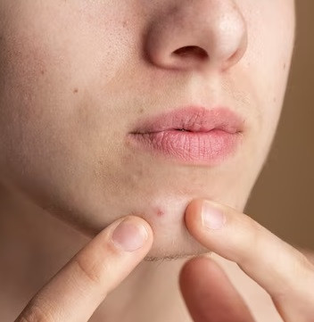 6 Rekomendasi Dokter Kulit untuk Menghilangkan Jerawat di Dagu