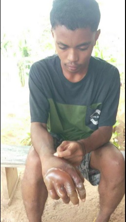 Tega, Guru SMK di Flores Timur Paksa Siswanya Celupkan Tangan ke Air Mendidih