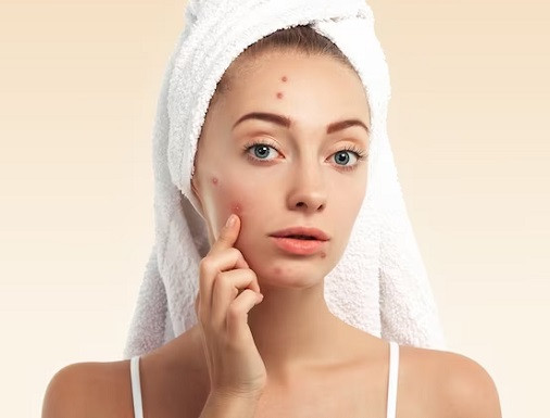 Beauty Hacks: 5 Paket Perawatan untuk Kulit Berjerawat, Bikinnya Mudah Banget!