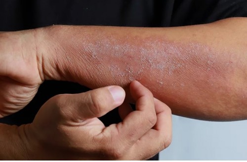 Ketahui Ini Penyebab hingga Cara Atasi Eksim