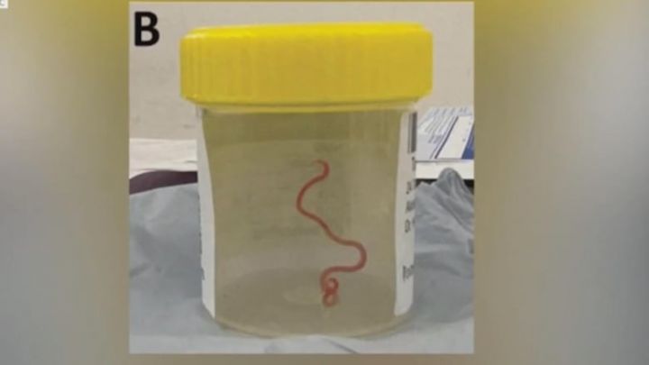 Ngeri, Dokter Bedah Temukan Cacing Hidup di Otak Perempuan Australia