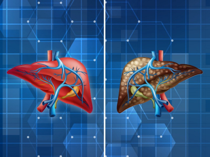 Penyebab dan Gejala Gagal Hati