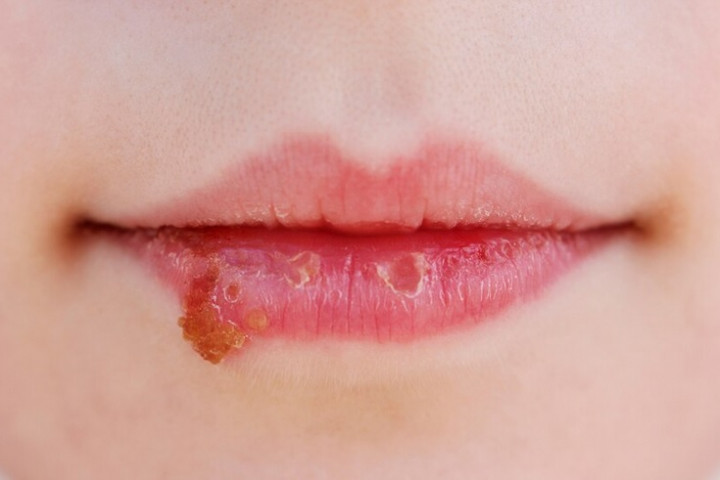 Xerostomia atau Mulut Terasa Kering, Mengapa Bisa Terjadi?