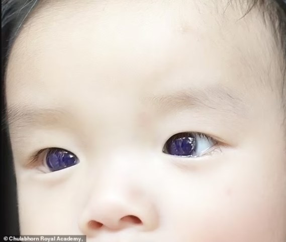 Mata bayi asal Thailand berubah warna setelah diberikan pengobatan Favipiravir. (Foto: Dok. Chulaborn Royal Academy/Dailymail.co.uk)