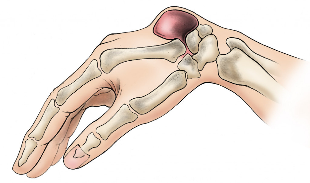 Apakah kista ganglion itu berbahaya? Berikut informasi selengkapnya. (Foto: Dok. Orthoinfo)