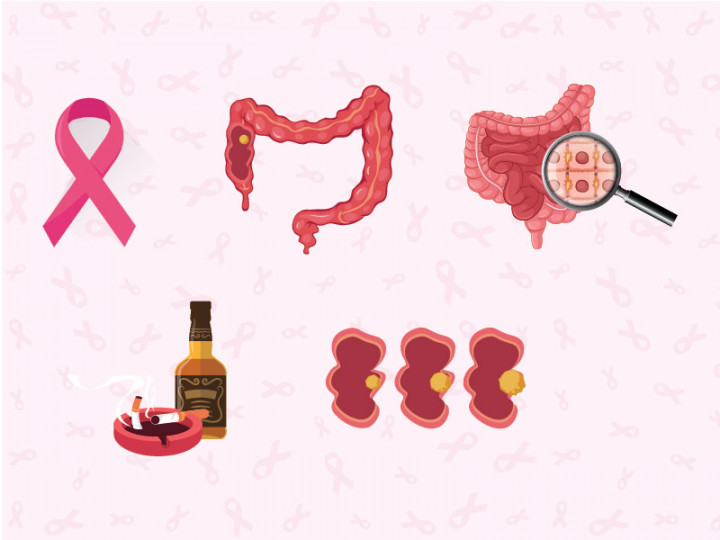 Mengenal Kanker Usus Besar