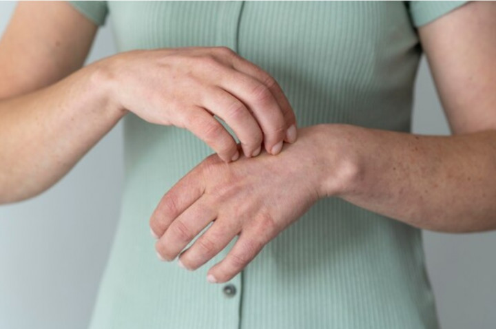 Dikonfirmasi Satu Kasus di Jakarta, Ketahui Lebih Dalam Cacar Monyet