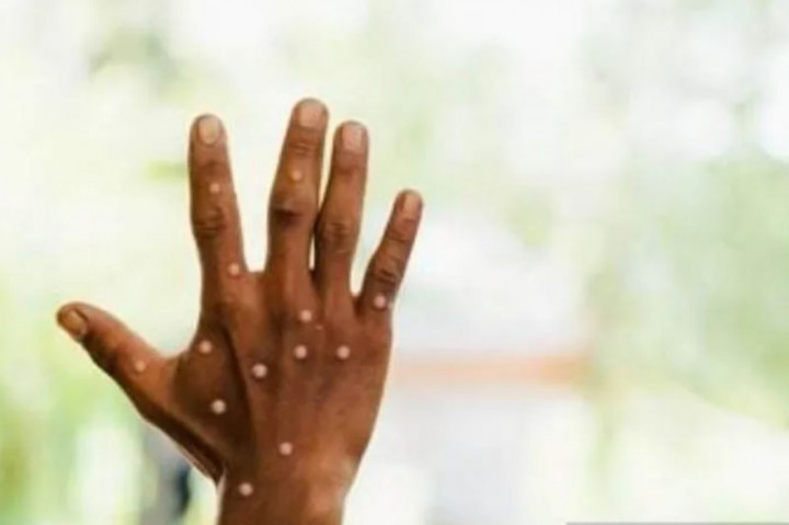 Kontak Erat Pasien Terkonfirmasi Cacar Monyet di DKI Ditelusuri