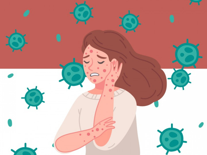 Cara Mencegah Cacar Monyet