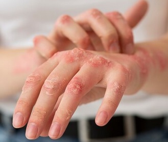 Kemenkes Ungkap Seks Berisiko Sebabkan Cacar Monyet Bertambah