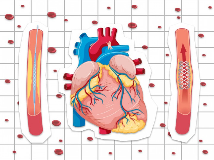 Apa Itu Ring Jantung dan Apa Fungsinya?
