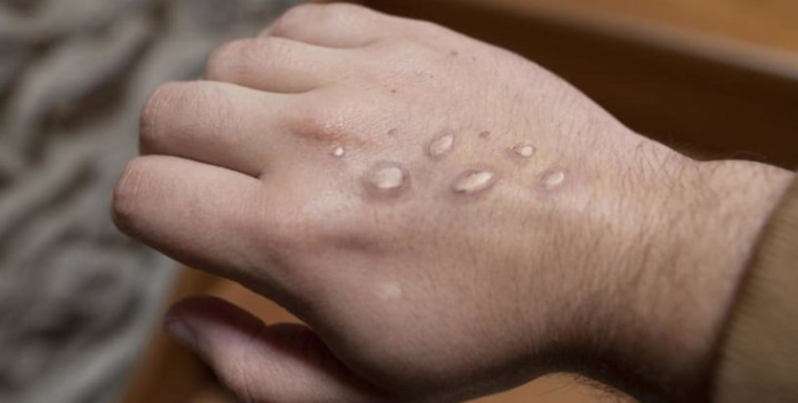 Simak! Begini Cara Melindungi Diri Kamu dari Paparan Cacar Monyet