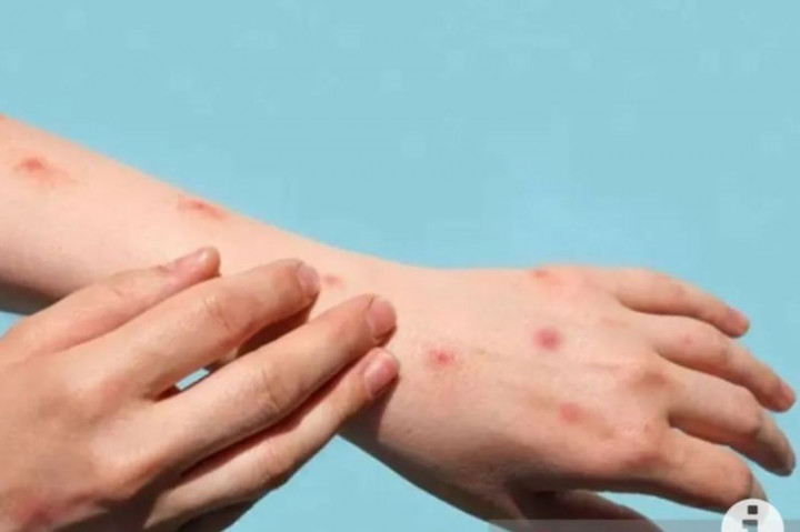 Sekeluarga di Cianjur Diperiksa terkait Cacar Monyet