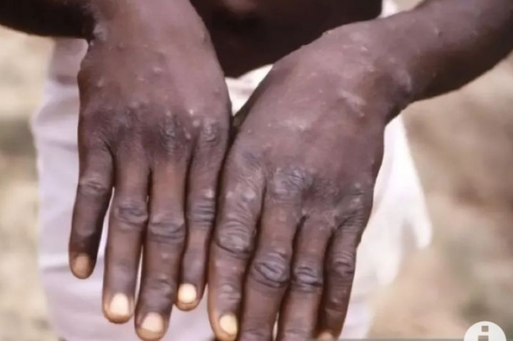 Warga Bekasi Positif Cacar Monyet Jalani Isolasi di Rumah Sakit