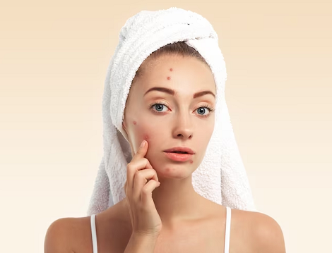 Cara Alami Mengobati Jerawat Meradang dan Pencegahannya