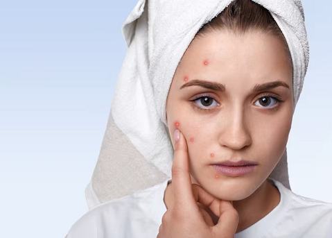 Ladies Wajib Tahu! Ini Bahayanya Memencet Jerawat Sembarangan