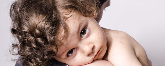 7 Pantangan Saat Anak Terkena Campak