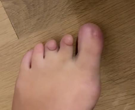 Kondisi langka seorang perempuan terlahir tanpa kuku di jari kaki. Foto: TikTok @annabelleeanderson