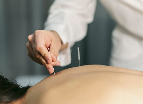 Catat! 6 Manfaat Akupunktur dalam Perawatan Paliatif Kanker