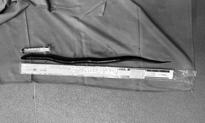 Mengejutkan! Alami Sakit Perut, Ternyata Belut Hidup dalam Tubuh Pria Ini