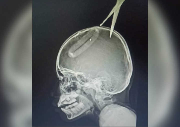 Tiru Adegan Film, Bocah 4 Tahun Tusuk Kepala Kakaknya dengan Gunting