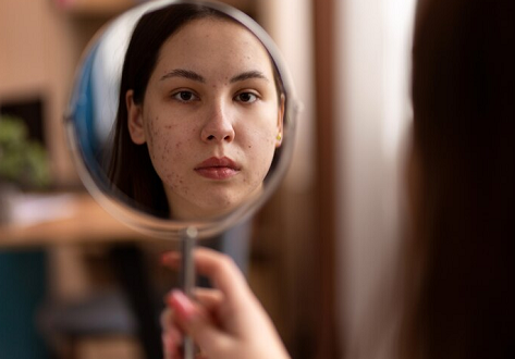 7 Masalah Kulit Wajah yang Sering Dialami Wanita dan Cara Mengatasinya