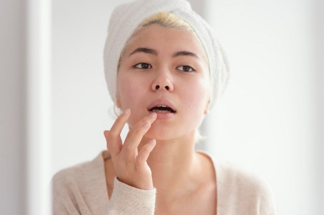 Begini cara mengatasi bibir kamu yang kering. (Foto: Ilustrasi/Dok. Freepik.com)