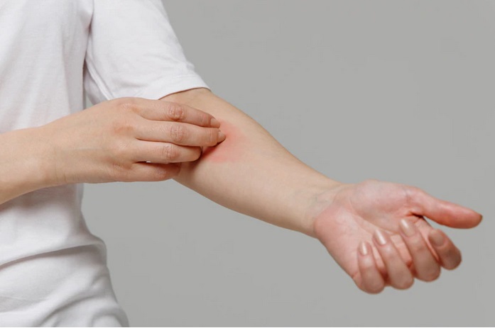 Fakta tentang Penyakit Lupus, Salah Satunya Bikin Rambut Menipis