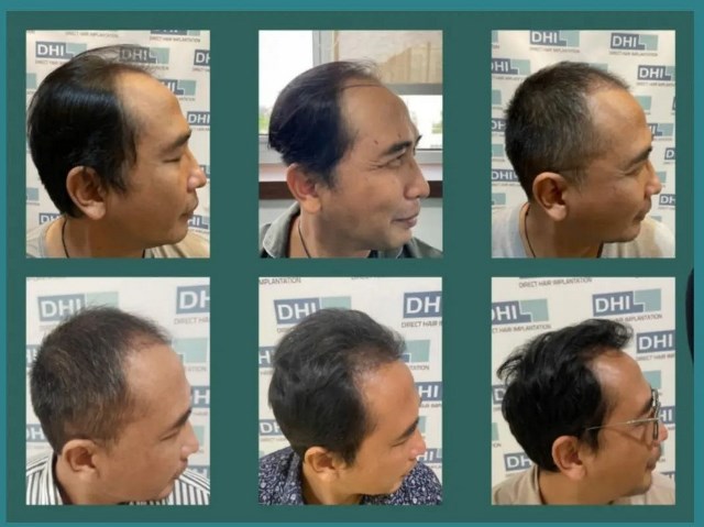 Apa sih transplantasi rambut? Simak selengkapnya. (Foto: Instagram Farmanina DHI Indonesia Hair Transplant Clinic/@dhi.indonesia)