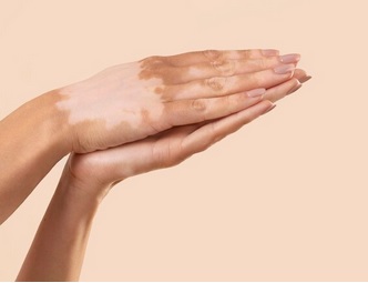 Punya Vitiligo? Begini Cara Merawat Kulit dengan Benar