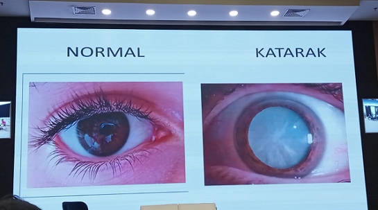 Perbedaan kondisi mata normal dan mata dengan katarak. (Foto: Dok. Yuni Yuli)