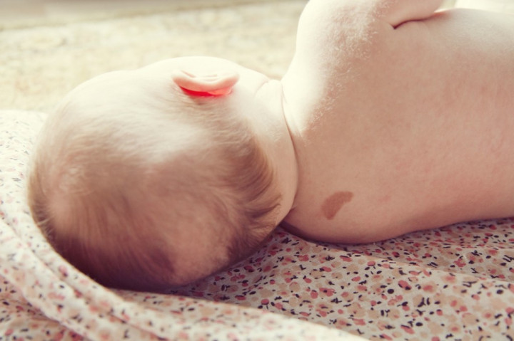 8 Cara Menghilangkan Tanda Lahir, Bisa Pakai Bahan Alami hingga Operasi