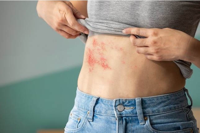 Disebut Lebih Nyeri dari Melahirkan, Ini Penjelasan Cacar Api