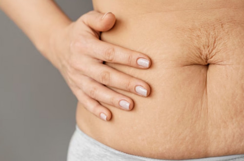 Sedot Lemak Cara Instan Turunkan Berat Badan? Ini Penjelasan Dokter