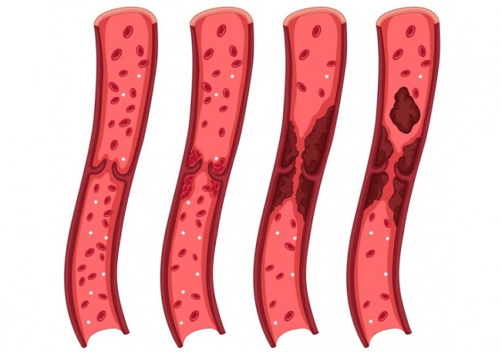 Ketahui, Ini Penyebab dan Gejala Trombosit Tinggi