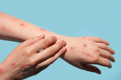 Perbedaan Mpox dan cacar air (Ilustrasi Freepik)