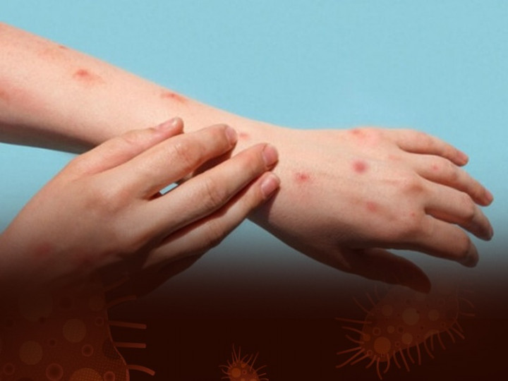 Kenali 5 Cara Penularan Mpox