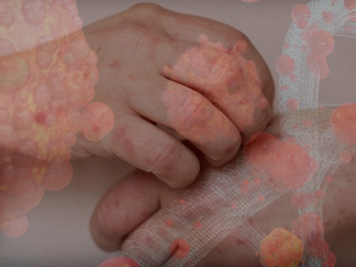 Apa Itu Penyakit Mpox?