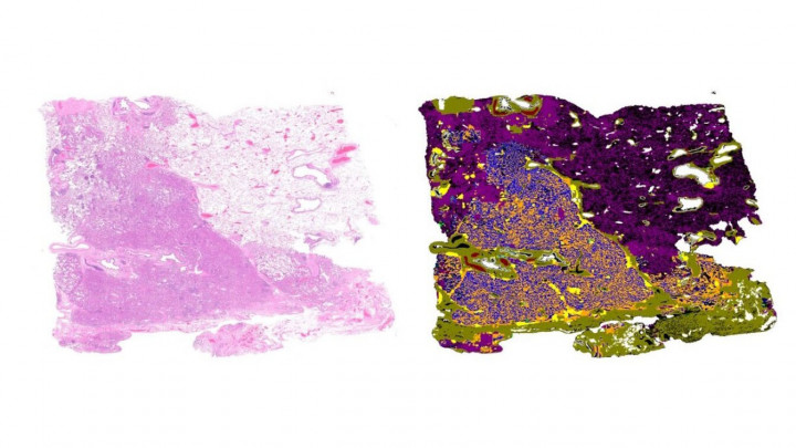 Cara AI Majukan dan Perawatan Kanker yang Dipersonalisasi