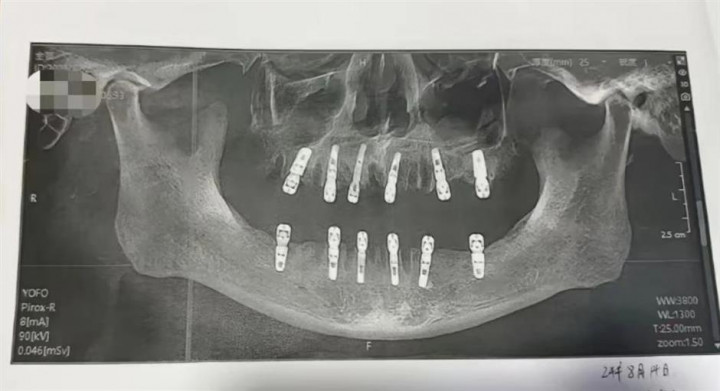 Pria di China Meninggal Dunia usai Cabut 23 Gigi dan Pasang 12 Implan Dalam Sehari
