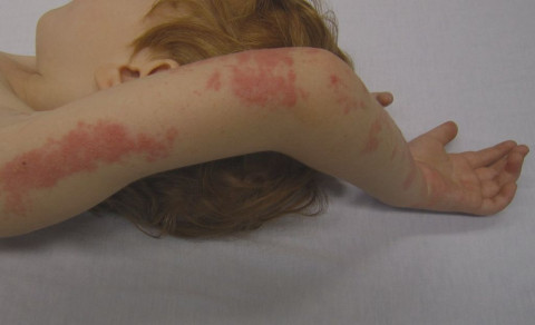 Wajib Tahu! Ini Gejala, Penyebab, hingga Cara Penularan Penyakit Herpes