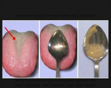 [Cek Fakta] Cek Kesehatan Menggunakan Sendok Makan, Ini Faktanya