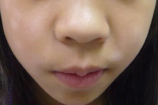Pityriasis Alba, foto: Instagram @dr.gungde_kresna