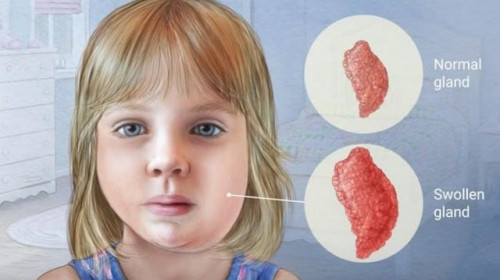 Kasus Gondongan Tiba-tiba Naik Signifikan, Simak Gejala hingga Pengobatannya