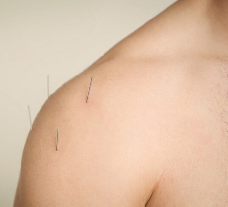 Cek Fakta: Mitos Tusuk Jarum saat Stroke yang Harus Dihilangkan