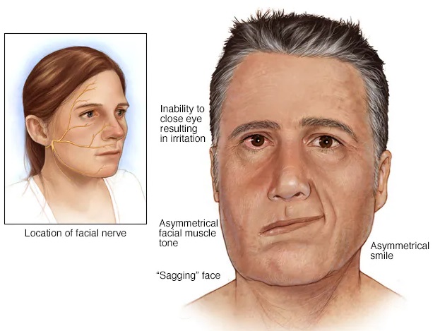 Bell’s palsy akan membuat separuh wajah tampak terkulai. Dok. Mayo Clinic